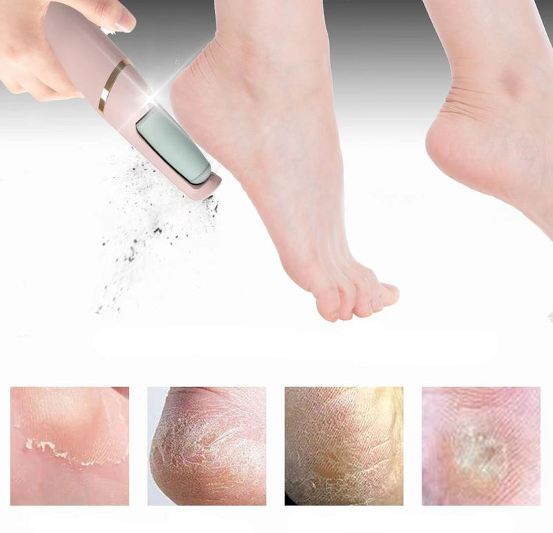 Soft Feet | Nooit meer eelt op je voeten!