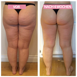 Anti-Cellulite-Cupping-Apparaat – SlimCupp