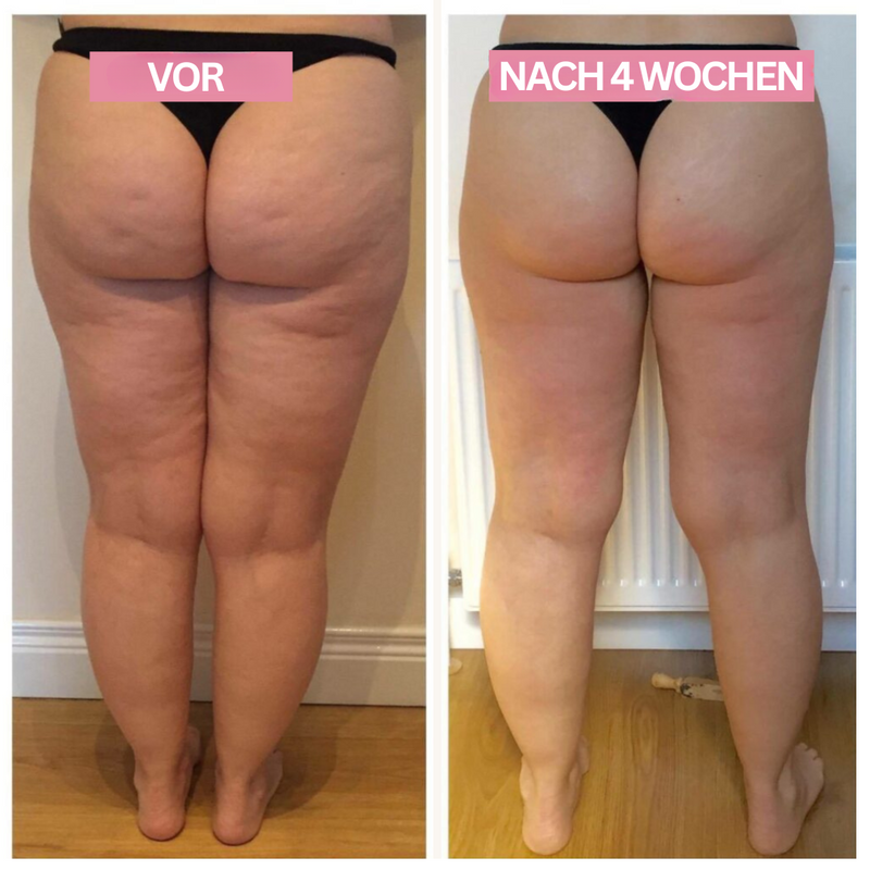 Anti-Cellulite-Cupping-Apparaat – SlimCupp